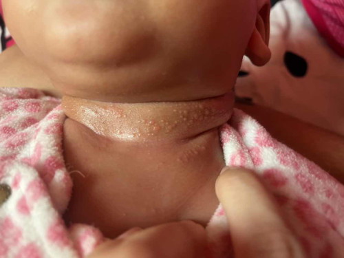 ผื่นอะไรผื่นแพ้บีแพนเท้นใช่มั้ย