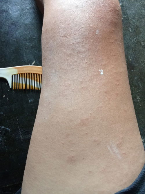 32+4d เป็นอาการเเบบนี้