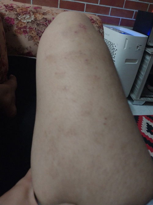 Ekzema masa mengandung