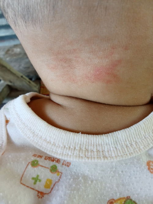 เป็นผื่นหรือน้องเป็นปานแดงคะ