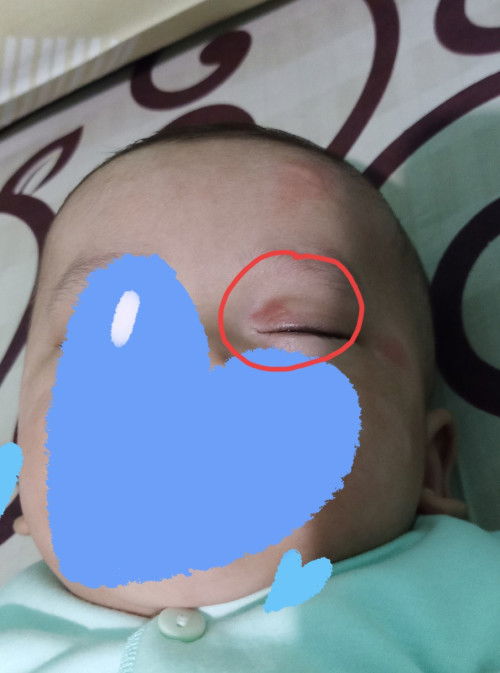 Atas mata bayi smpe skrg masih merah spt gatal
