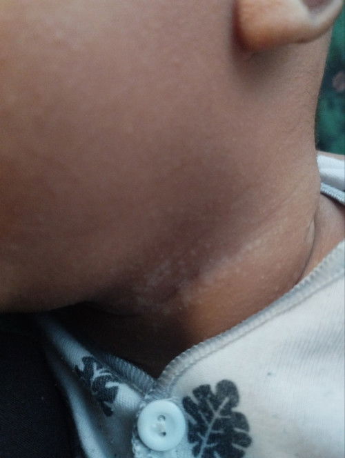 BERCAK PUTIH DI LEHER