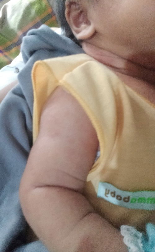 Kulit bayi merah merah