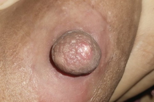 Mau tanya dong bun apa ada yang pernah kaya saya puting susu nya,. Mau tanya obat nya apa ya?π
