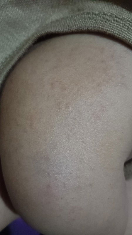 apakah termasuk ciri mau terkena cacar air