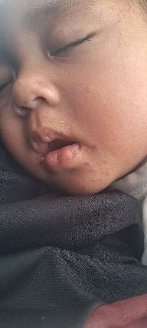 Cacar air pada bayi 11 bln