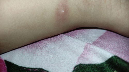 Bun ada yg pernah gni debay nya, awalnya bentol trs jdi kaya gni.. Gatau faktor lain jga huhuu