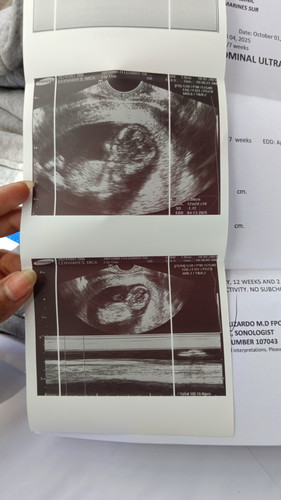 Trans v ultrasound