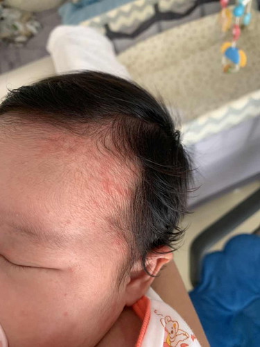 ผื่นบนหน้าทารกจะหายตอนกี่เดือนคะ