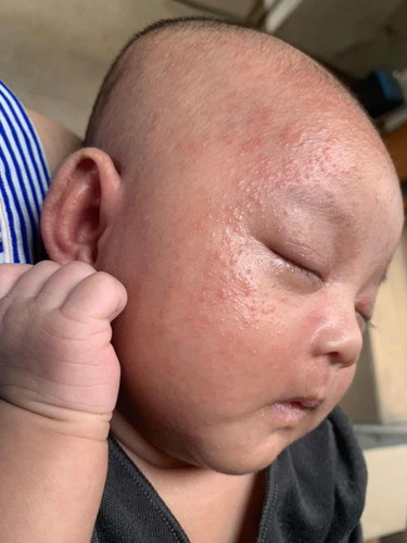 Ruam pada bayi usia 1 bulan 4 hari