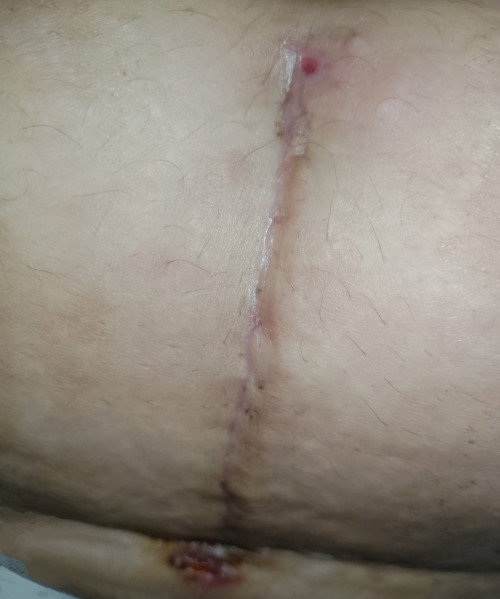 Tahi ng cs na nabutas