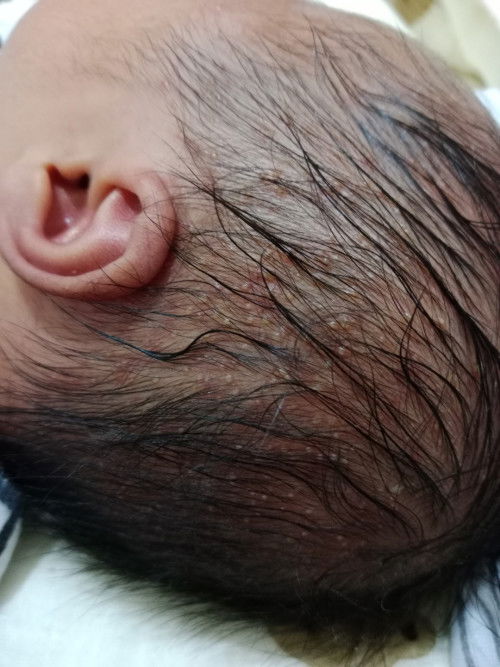 Kepala bayi bentol seperti cacar