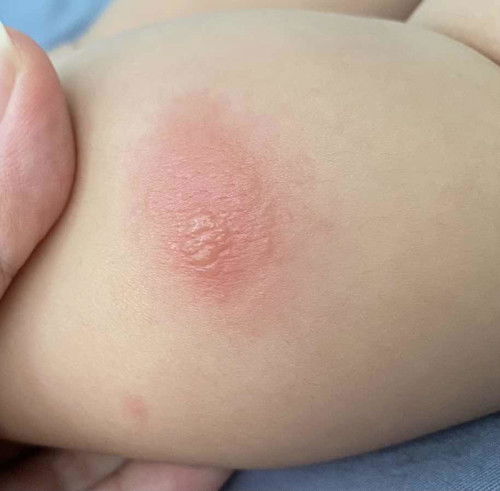 Gigitan serangga kah?