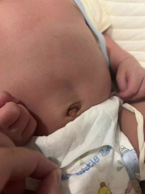 สะดือลูก 15 วัน แบบนี้เรียกว่าแฉะมั้ยคะ