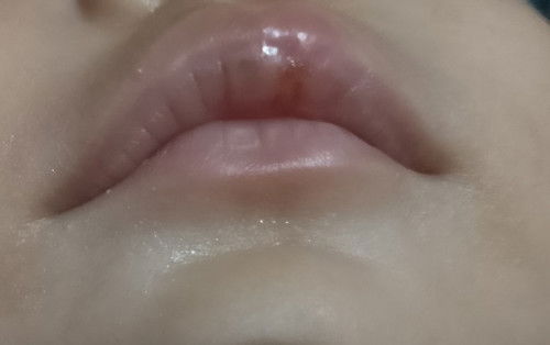 Bibir anak usia 6 bulan bengkak dan pecah