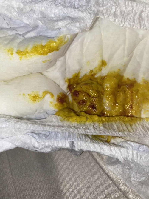 Traces of blood in my LO’s poop.