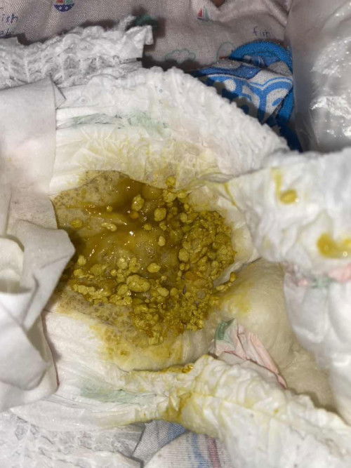 ถ่ายเป็นมูก เม็ดมะเขือ อันตรายมั้ย น้องทานนมแม่และนมผง