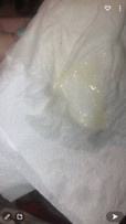 Creamy white discharge at 31weeks