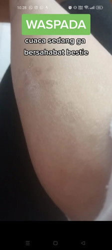 Bercak hitam gak tau panu atau apa tapi gatel