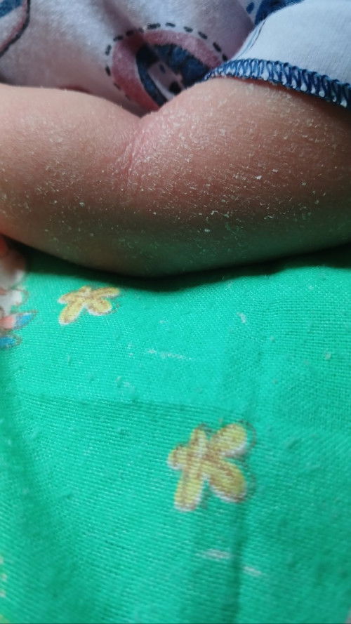 Kulit bayi kering terkupas