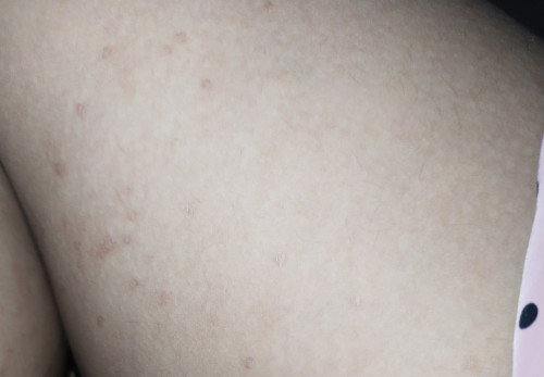 Bintik-bintik di kulit paha dan lengan tangan ketika hamil 31week
