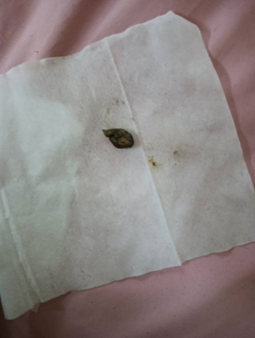 อึแข็ง สีดำ ปกติไหม