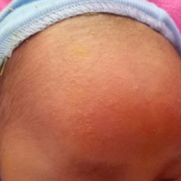 Beruntusan atau biang keringat