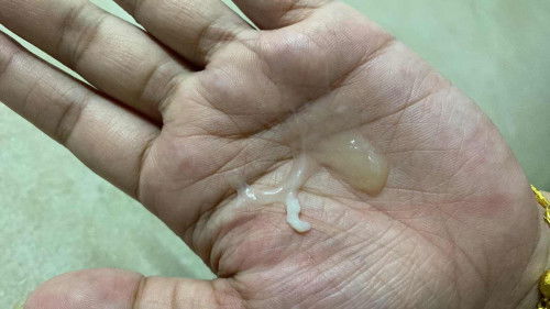 มูกใกล้คลอดหรือมูกปกติ