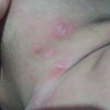 benjolan dikepala bayi