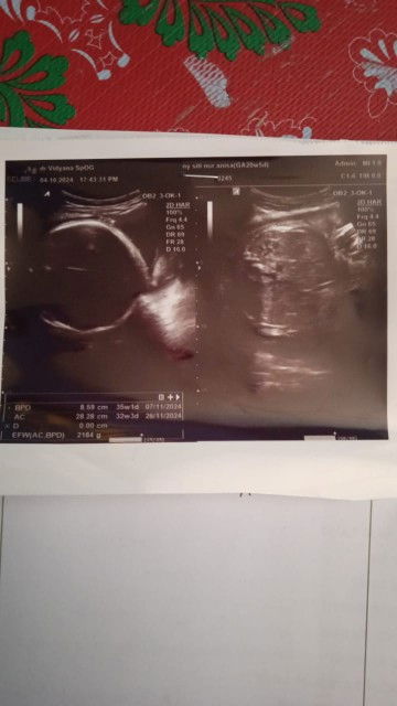 BPD melebihi usia kandungan