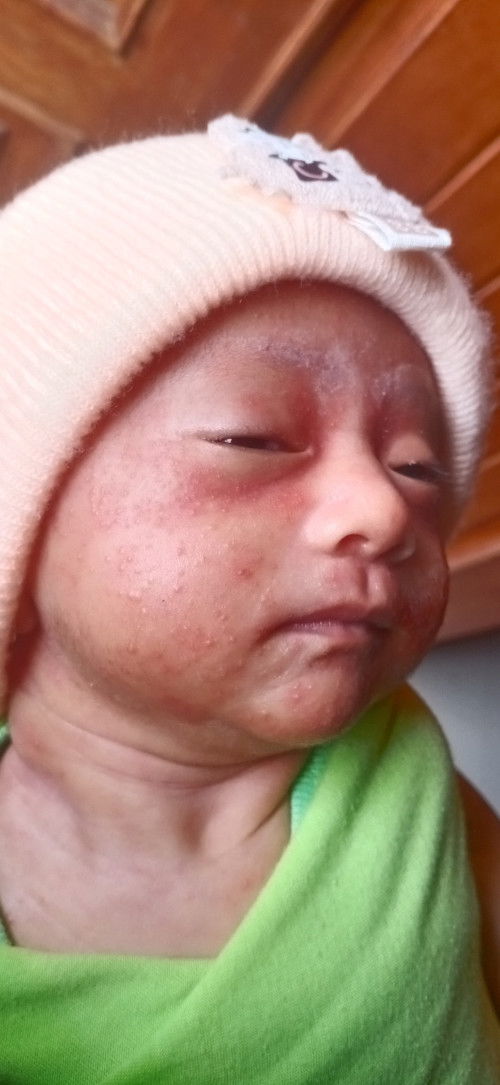 wajah bayi berbintik merah