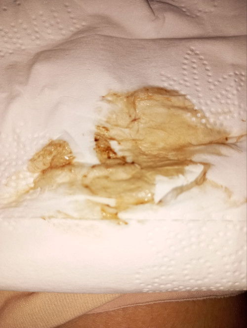 E bầu 5 tuần hay bị ra dịch màu nâu có sao k ạ