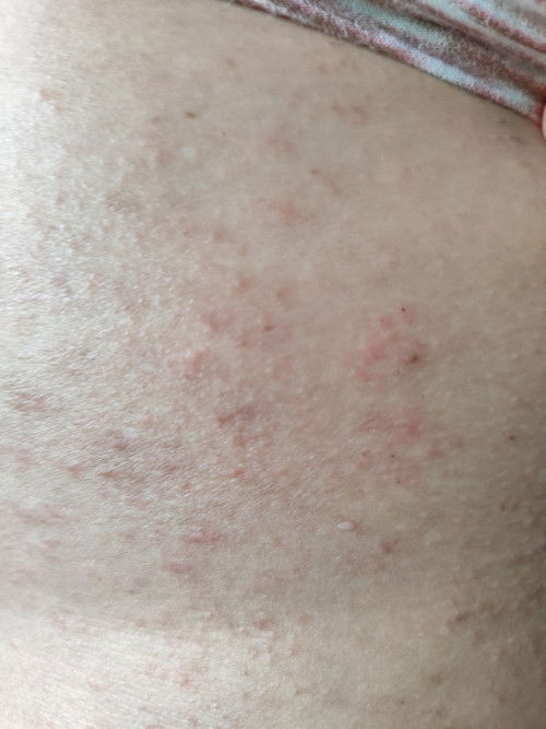 Gatal pada perut, paha, payudara di kehamilan 22 week