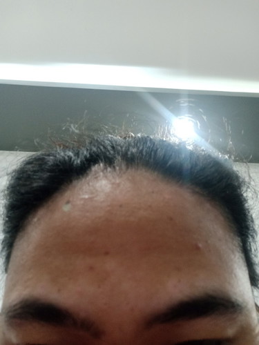 ano po kayang pwede lng gamot sa an-an sa mukha habang buntis ?
