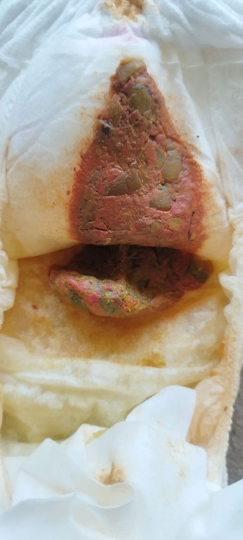 แบบนี้คือ ถ่ายเป็นเลือดไหมค่ะ