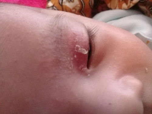 Kelopak mata bayi merah