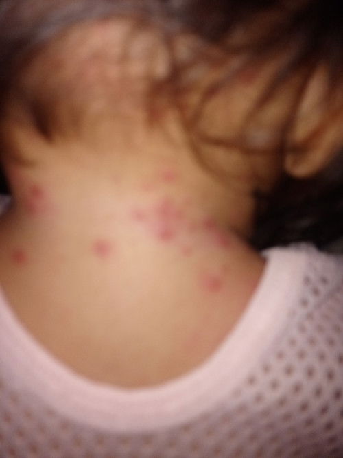 Ano Po kaya sa leeg Ng baby ko