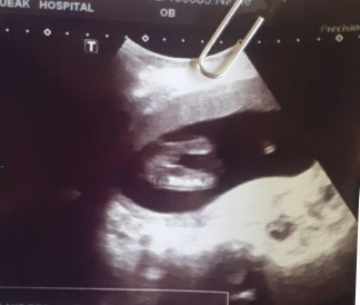 สอบถามแม่ๆค่ะไปซาวตอน 16 วีค 4วัน 😊😊