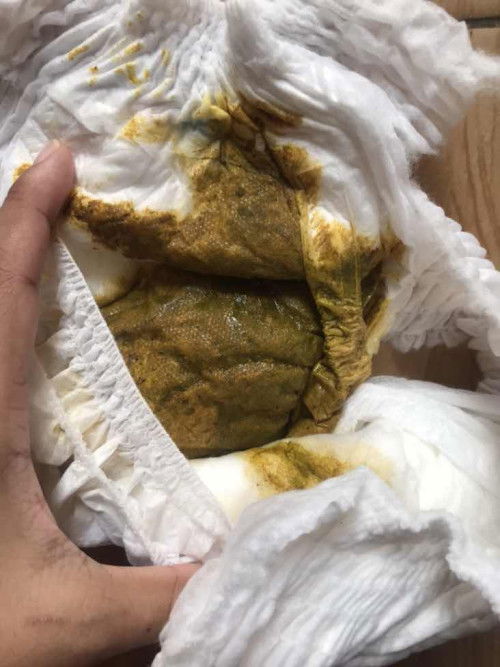 สอบถามหน่อยค่ะแม่ๆ ลูกอึ๊เป็นสีนี้ เป็นอะไรไหมคะ หรือปกติ