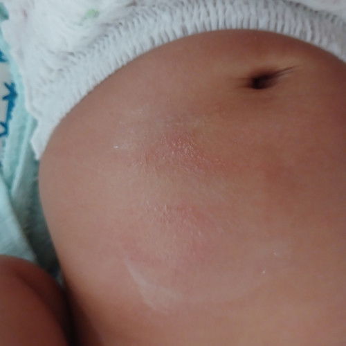 ตุ่มที่ท้อง