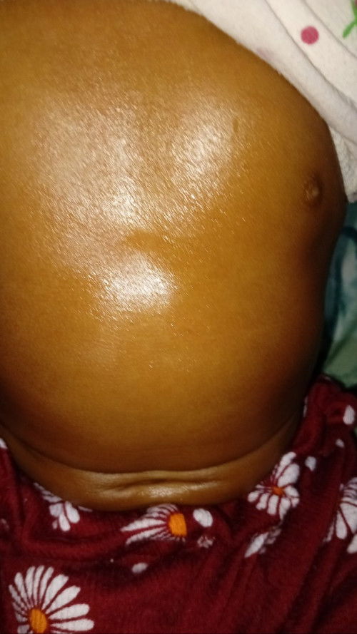 Cekung pada ulu hati