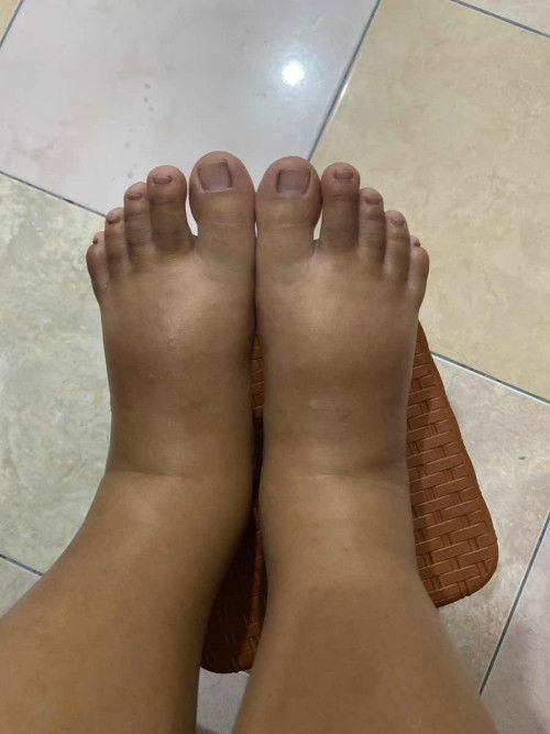 Kaki bengkak setelah melahirkan