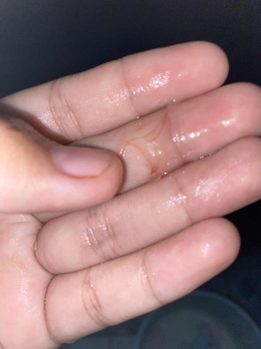 40วีคมีมูกเลือดกับมูกใสไม่ปวดบีบท้องควรไปหาหมอไหมค่ะ