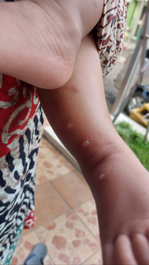 Kulit bayi bentol2 melenting keluar air