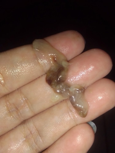 Mucus plug?