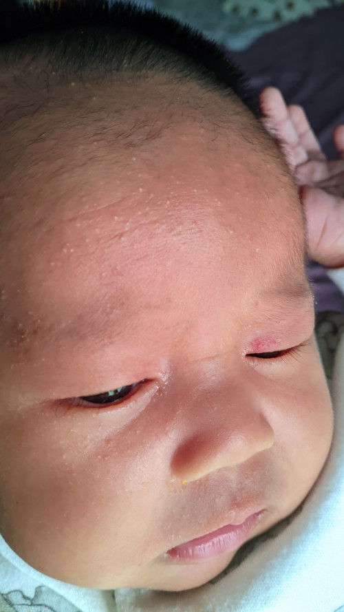 kelopak mata merah dari lahir sampai sekarang usia 1 bulan