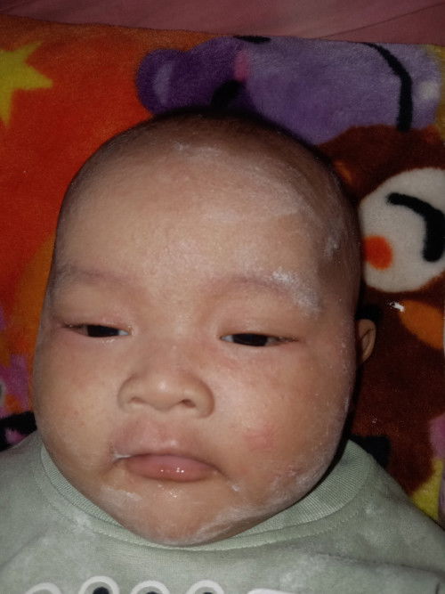 Biang keringat pada sikecil