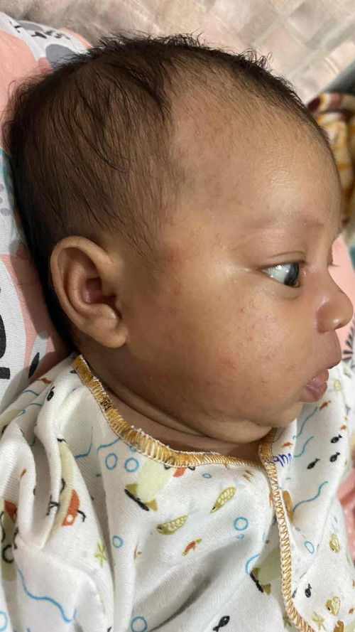 Ruam asi atau kenapa ya?