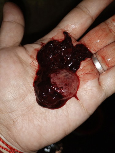 Posible po bang nalaglagan ako