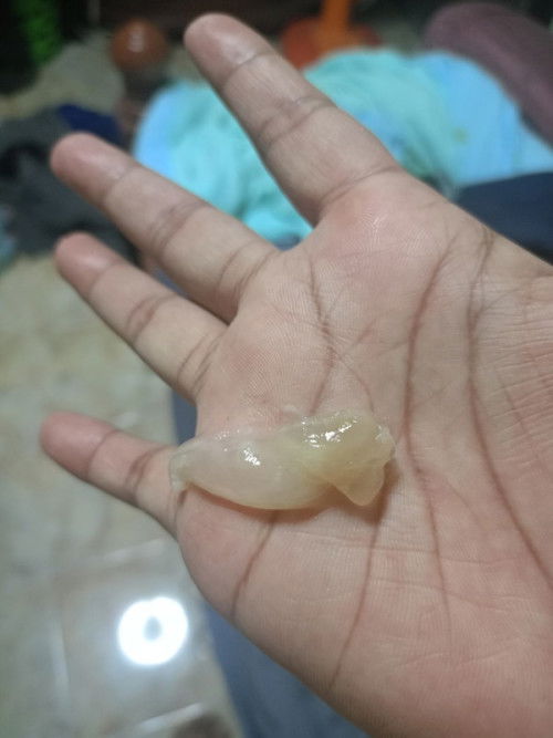 มีแม่คนไหนเคยเป็นไหมคะ 
ตอนนี้ 31 w มีมูกออกมาแบบนี้ คือเริ่มเตือนแล้ว หรือ มูกปกติคะ